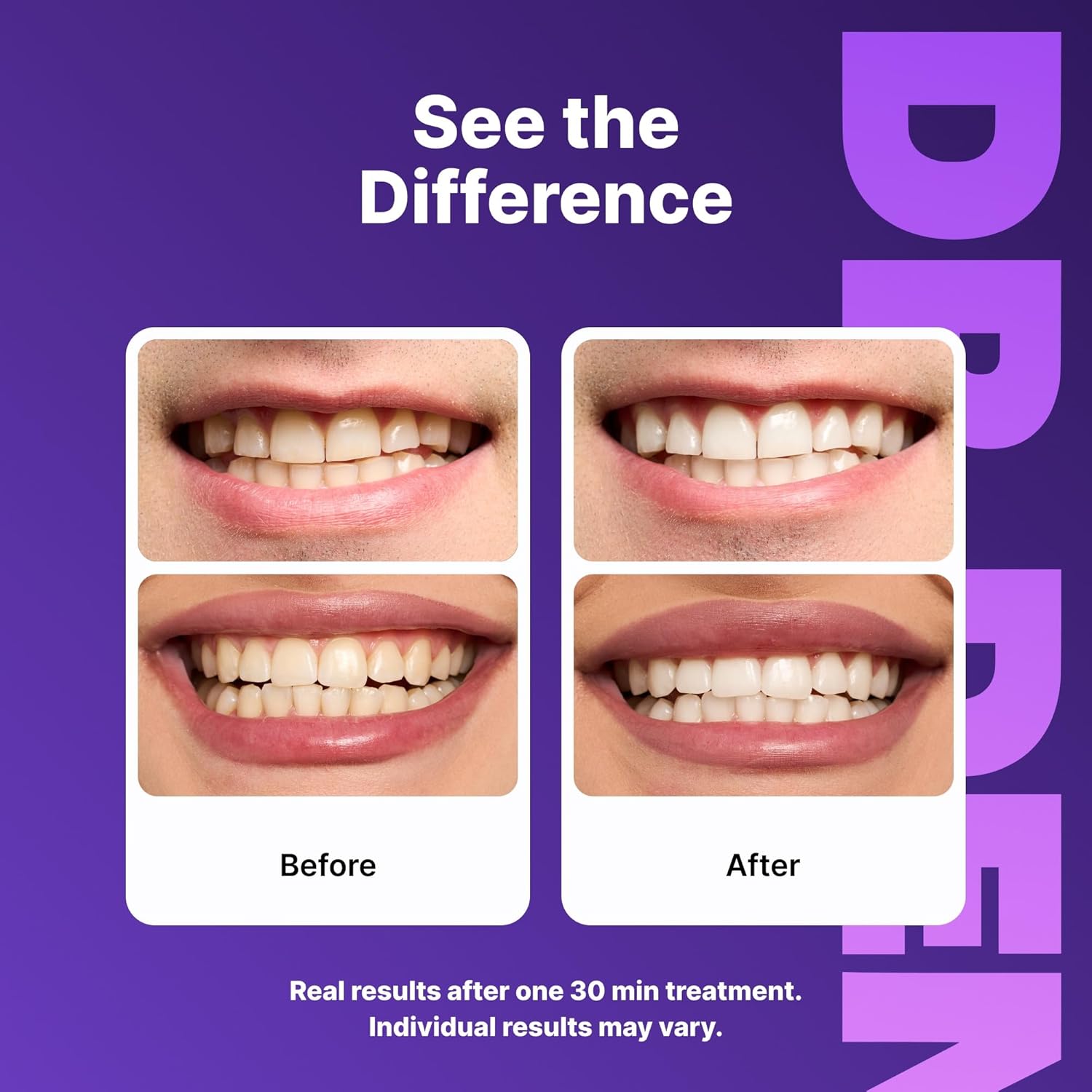 Purple Smile Whitening Strips